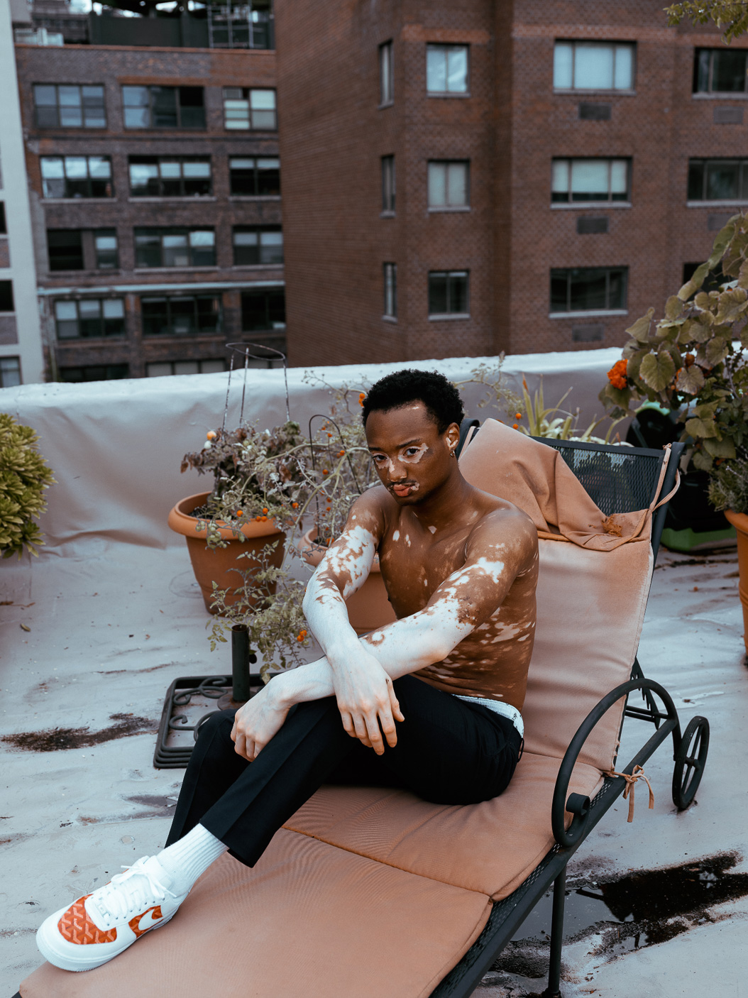 Quis - Vitiligo 